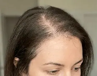 Before — Scalp microneedling — crown density improvement